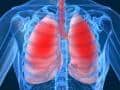 pulmonary disease